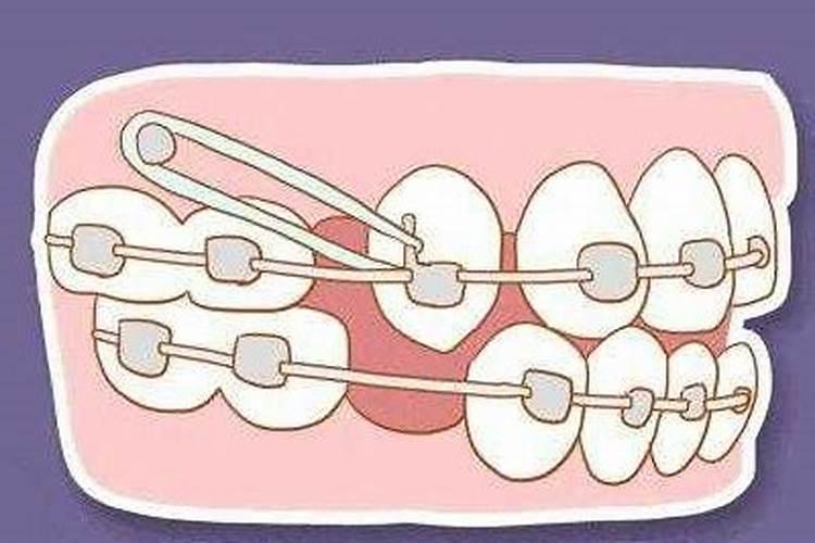 正畸中戴用橡皮圈的注意事项有哪些问题